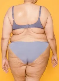 The History of Cellulite